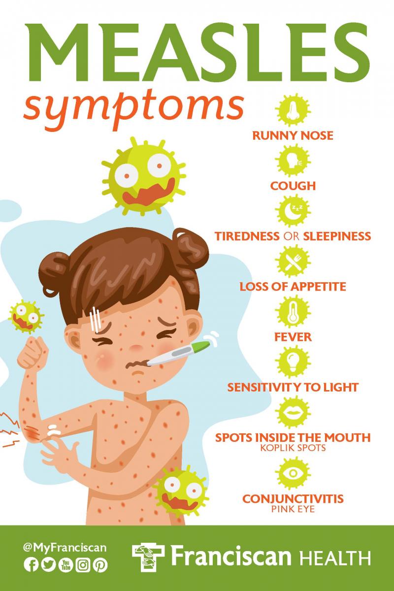 The Most Common Measles Symptoms | Symptoms of Virus