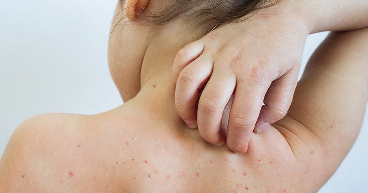 The Most Common Measles Symptoms